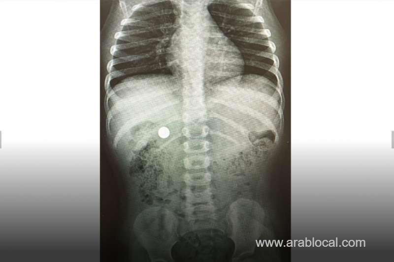 child-saved-after-swallowing-battery_bahrain