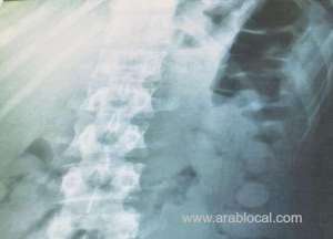 man-accused-of-smuggling-drug-in-stomach_kuwait